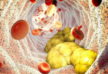 एमाइलॉयडोसिस कैंसर- जानलेवा बीमारी