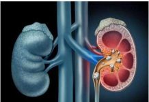 पथरी रोग – विद्यावाचस्पति डॉक्टर अरविन्द प्रेमचंद जैन भोपाल