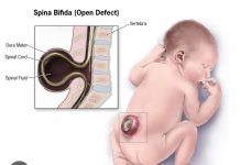 स्पाइना बिफ़िडा —- विद्यावाचस्पति डॉक्टर अरविन्द प्रेमचंद जैन भोपाल